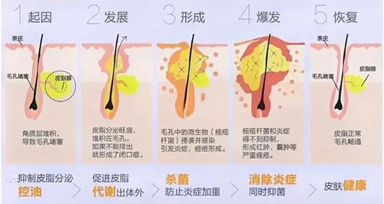 痘痘的成因